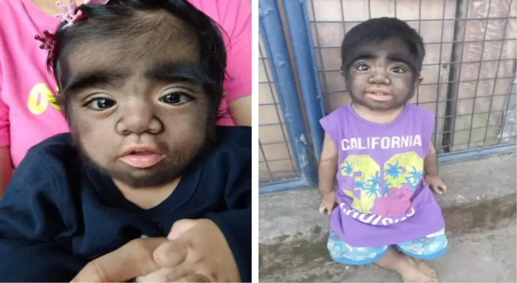 ফিলিপাইনের আপায়াও অঞ্চলের শিশু জারেন গামোগানের মুখ ও শরীরের বিভিন্ন অংশে জন্ম থেকেই অতিরিক্ত লোম রয়েছে। গ্রাফিক্স: আমেরিকা বাংলা