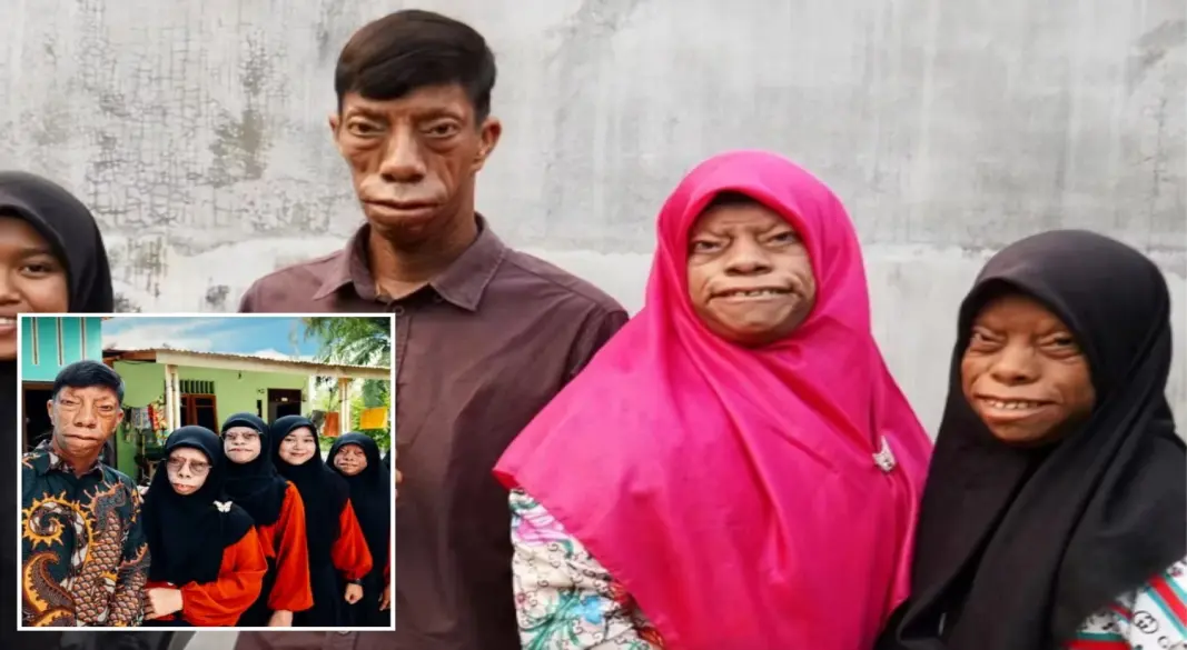 ইন্দোনেশিয়ার মানুরুং পরিবারের সদস্যরা ট্রিচার কলিন্স সিনড্রোমের সঙ্গে বসবাস করছেন এবং সামাজিক যোগাযোগমাধ্যমে নিজেদের জীবন তুলে ধরছেন। গ্রাফিক্স: আমেরিকা বাংলা