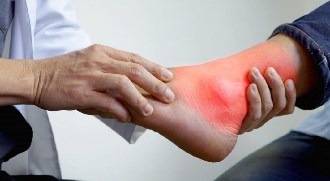 হঠাৎ জয়েন্টে ব্যথা, হাঁটুর বা পায়ের আঙ্গুলে ফোলা বা অজানা শক্ত হয়ে যাওয়া এসব উপসর্গের পেছনে লুকিয়ে থাকতে পারে ইউরিক অ্যাসিডের সমস্যা। ছবি: সংগৃহীত