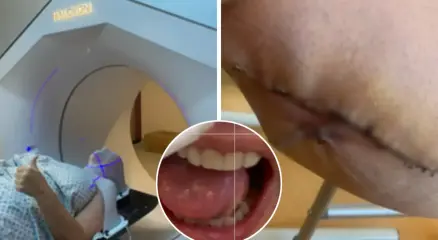 জিভের ক্যানসারকে সাধারণ ঘা ভেবে ভুল রোগ নির্ণয়, অবশেষে পা কেটে জিভ পুনর্গঠন